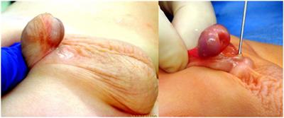 Results of Onlay Preputial Flap Urethroplasty for the Single-Stage Repair of Mid- and Proximal Hypospadias